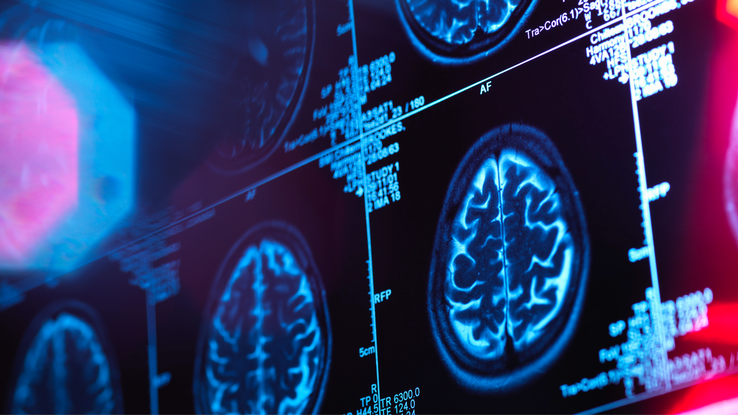 Neurologist reveals two early signs of dementia that aren’t to do with memory