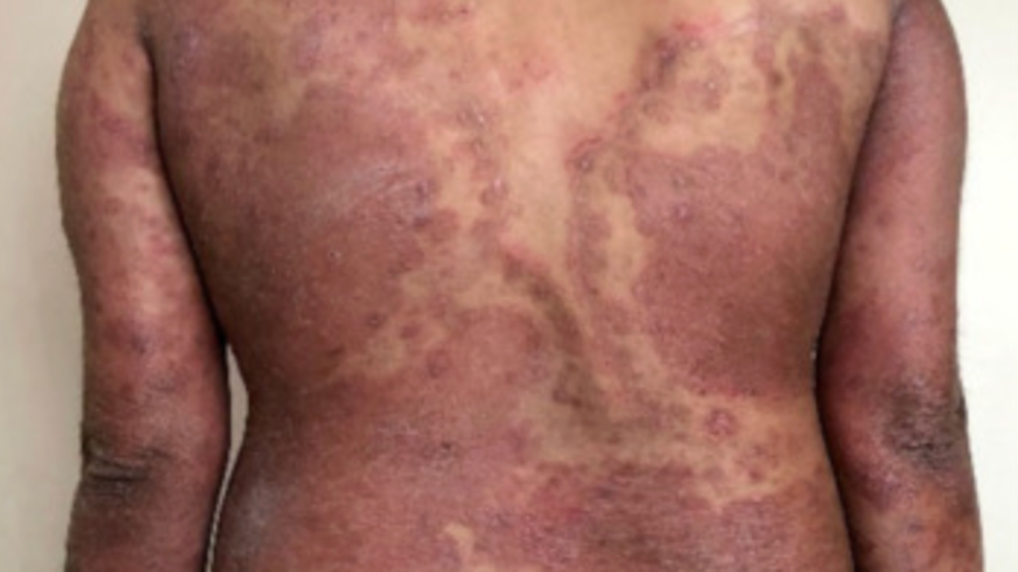 Propagation rapide des champignons au Royaume-Uni